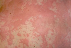 phototake-rm-hives_urticaria_skin_rash